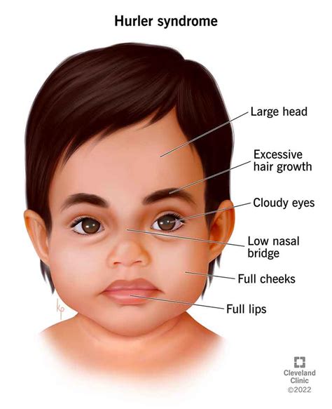Mucopolysaccharidosis Type I Hurler Syndrome Symptoms And Causes