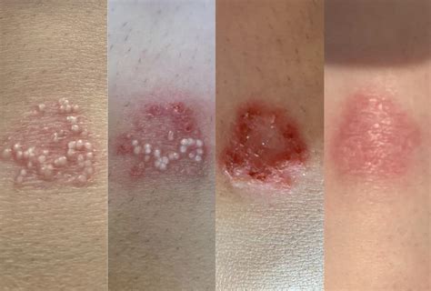 Traumatic Milia Knee Healing Update Before During After 4 Days