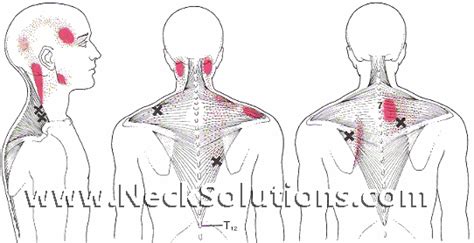 Trapezius Myalgia Chronic Neck And Shoulder Pain Help