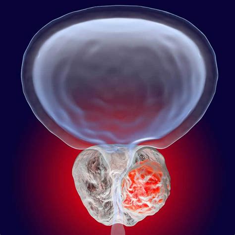Cancer De Prostata Imagenes