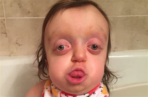 A Girl Born With A Severely Deformed Head Smiles In Spite Of Strangers Labeling Her An Alien