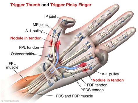 When attaching the fpl tendon to the feeding catheter, a gap is left when suturing the two together. Medmovie.com | Tendon Rupture Following Trigger Finger Release