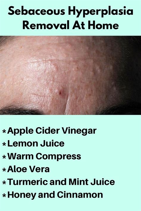 Sebaceous Hyperplasia Removal At Home How To Remove Fresh Aloe Vera
