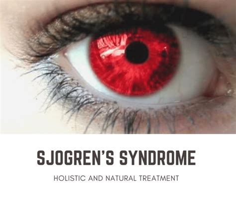 Natural Treatments For Sjogrens Syndrome Part 3
