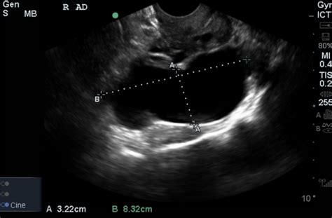 Ultrasound Case Series 1 Not Pregnant But — Everyday Ebm