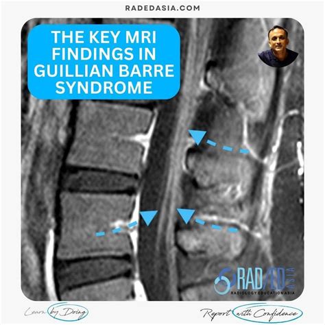 MRI FINDINGS IN GUILLIAN BARRE SYNDROME Radedasia