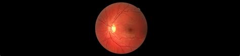 Digital Retinal Photographs Taylors Optometrists