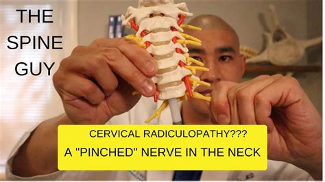 Cervical Stenosis Radiculopathy Part 1 Symptoms Imaging And Patient