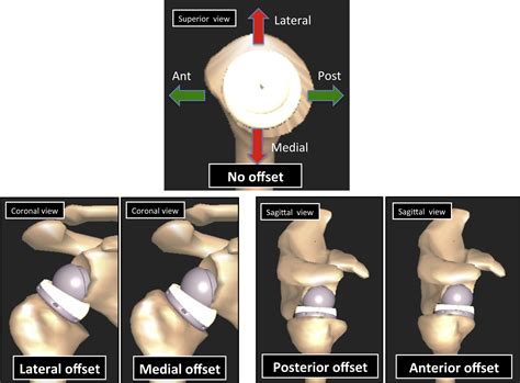 Effects Of The Humeral Tray Component Positioning For Onlay Reverse