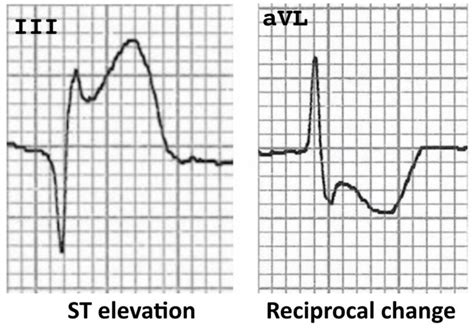 Nonspecific ecg changes in acute stroke has therefore posed much diagnostic and. The ST Segment | Nursing information, Ekg