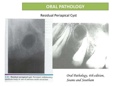 Periapical Cyst Radiology