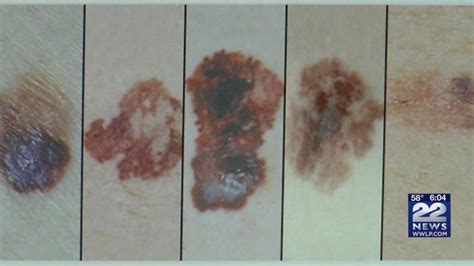 Melanoma Monday What Are The Warning Signs Of Skin Cancer