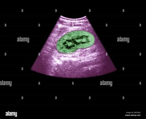 Kidney Ultrasound Scan Stock Photo Alamy