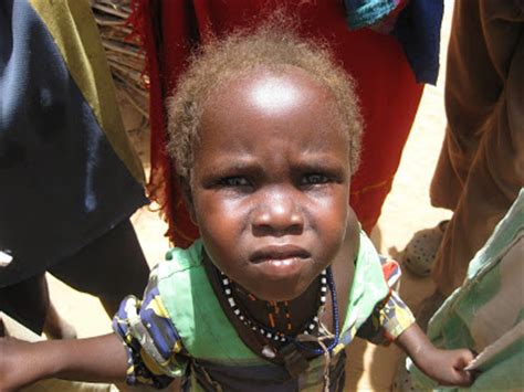 Hair loss, also known as alopecia or baldness, refers to the loss of hair from the scalp or the entire body. Somalis with blonde hair.. - Page 2 - SomaliNet Forums