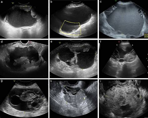Imaging In Gynecological Disease 11 Clinical And Ultrasound Features