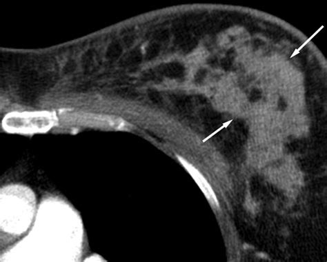 Breast Lesions Incidentally Detected With Ct What The General