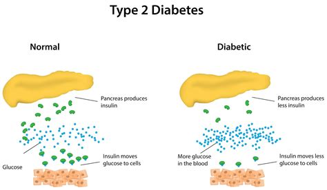 Online Products Lane: How to cure type 2 diabetes