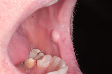 Fibroma Tongue