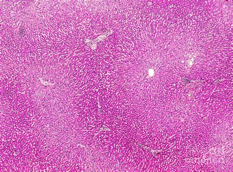 Liver Edema Photograph By Nigel Downerscience Photo Library Pixels