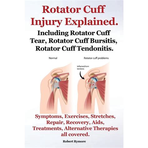 Rotator Cuff Injury Explained Including Rotator Cuff Tear My XXX Hot Girl
