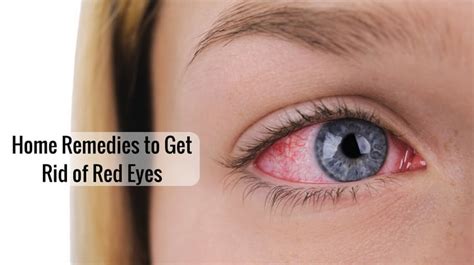 11 Best Remedies To Get Rid Of Red Eyes Naturally