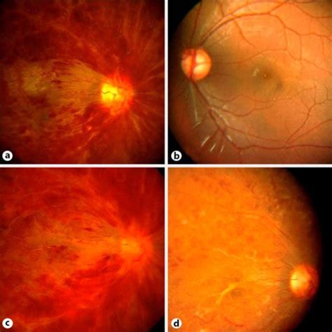 Fundus Photographs Of Patients Right And Left Eye A Right Eye 2 Weeks