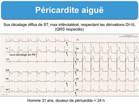 Nos coups de coeur sur les routes de france. Péricardite aiguë. 1 typique : e-cardiogram