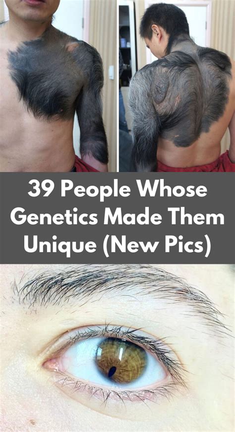 People Whose Genetics Made Them Unique New Pics In Genetics