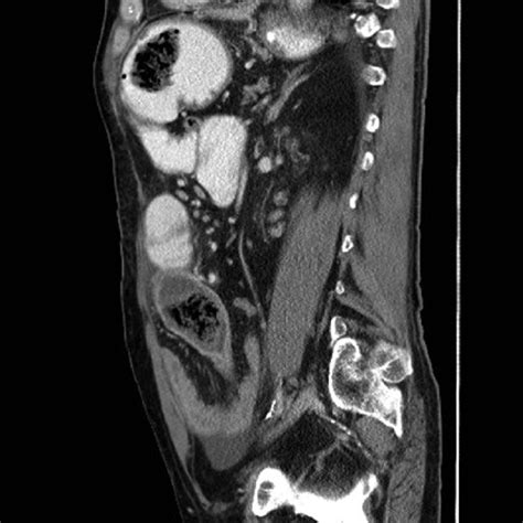 Contrast Enhanced Abdominal Ct Scan In Coronal View Showing Evidence Of