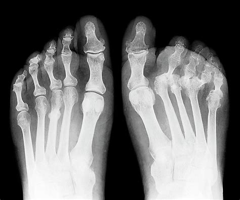 Rheumatoid Arthritis Foot And Ankle Almawi Limited The Holistic Clinic
