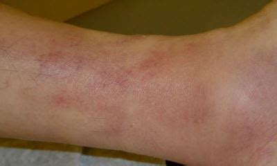 In this article, we take a look at what happens when a blood clot forms in the arm, the potential causes, and the treatment options. Deep vein thrombosis pictures, DVT symptoms pictures, DVT in leg symptoms pictures, warning ...