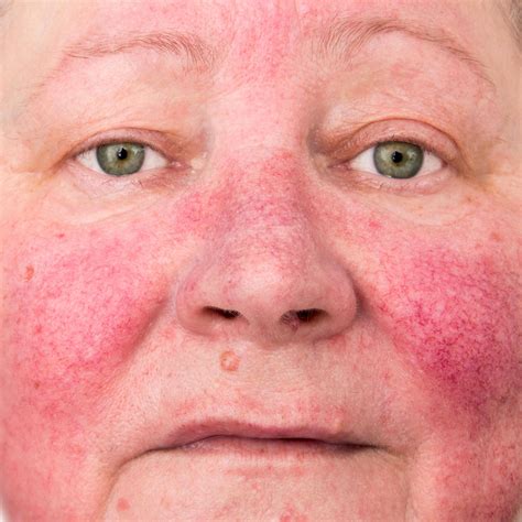 Dangerous Skin Diseases 5 Life Threatening Skin Rashes And Their Symptoms
