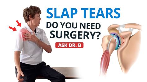 Shoulder Labral Tear Slap Lesion Do You Need Surgery Ask Dr B