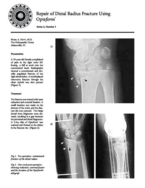 Series A No 3 Repair Of Distal Radius Fracture Using Opteform 713