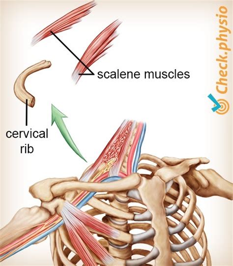 Thoracic Outlet Syndrome Physio Check