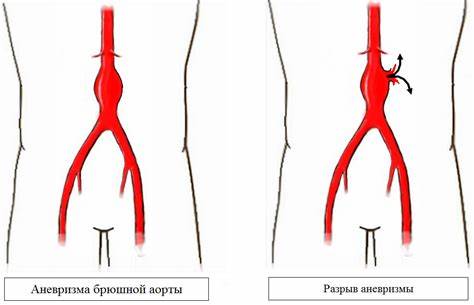 Диета аневризма брюшной аорты Аневризма брюшной аорты. Все что нужно знать. Аневризма брюшной аорты. Все что нужно знать. Диета аневризма брюшной аорты