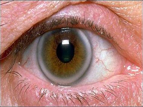 Bad Cholesterol High Ldl Look Into Your Eyes Let Your Cornea Tell