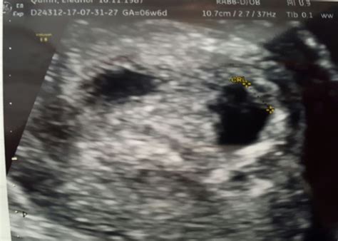 12 week pregnancy dating scan: 6 week ultrasound - Twins? | Mumsnet