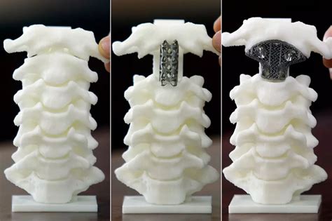 Chinese Boy Has 3d Printed Vertebra Implant In Surgical World First