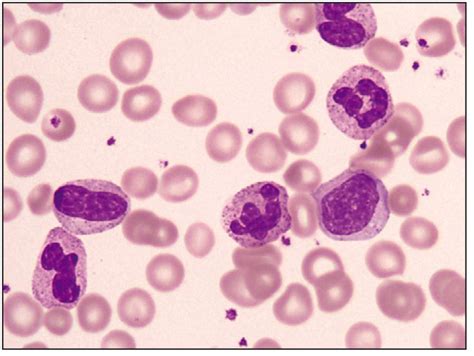 Leukemoid Reaction Left Shifted Neutrophilic Series With Neutro Phils