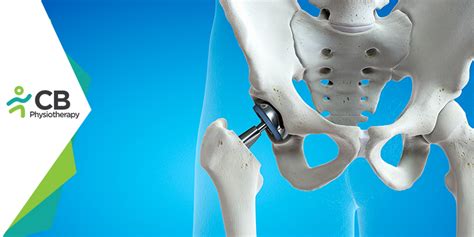 What Not To Do After Hip Replacement Surgery Blog By Cb Physiotherapy Active Healing For