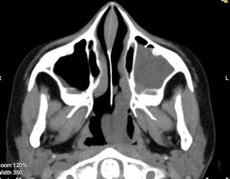 Ct Scan Axial Cut Showing A Large Homogenous Mass Extending Across The