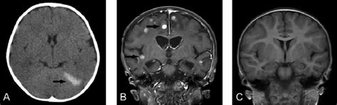 A Computed Tomography Indicated Left Tentorium Subdural
