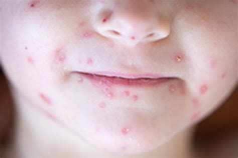 The Measles Outbreak And Immunosuppressed Children Boston Childrens