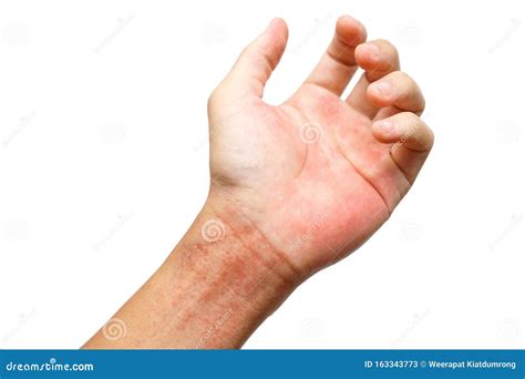 Skin Rash On Wrist