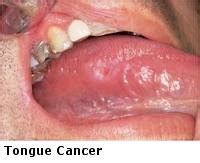 Do you know what tongue cancer symptoms look like? Ear, Nose, Throat & Sinus Specialists - Dr. Edgar Lueg ...