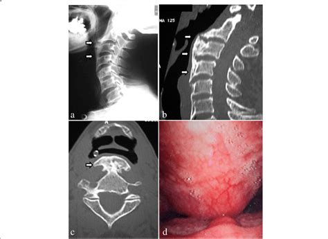 A A Recurrent Ossification Of The Anterior Longitudinal Ligament With