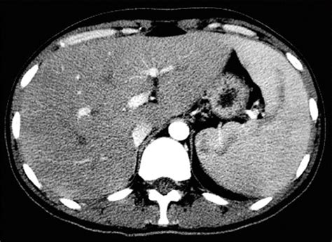 Abdominal Ct Demonstrating Both Hepatomegaly And Splenomegaly