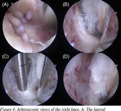 Figure From Diagnosing And Treating Popliteal Tendinopathy After