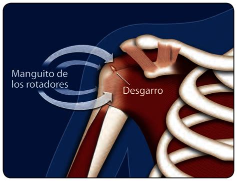 Visión general Marinero Actual dolor de hombro derecho ejercicios Garantizar Perú Tesoro